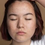 9 effective ways to treat acne during puberty 5