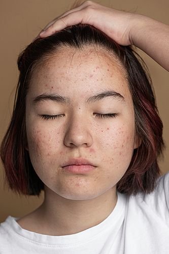 9 effective ways to treat acne during puberty 5